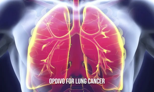 Opdivo for Lung Cancer