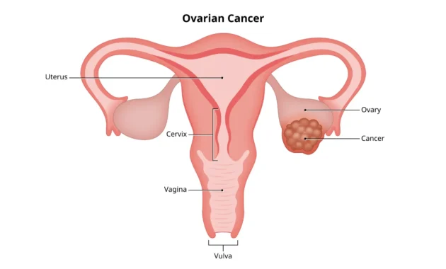 Ovarian Cancer Surgery Cost