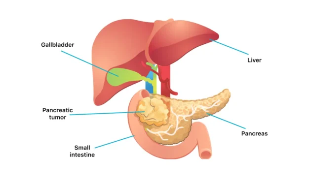 Pancreatic Cancer Spread to Liver How Long to Live