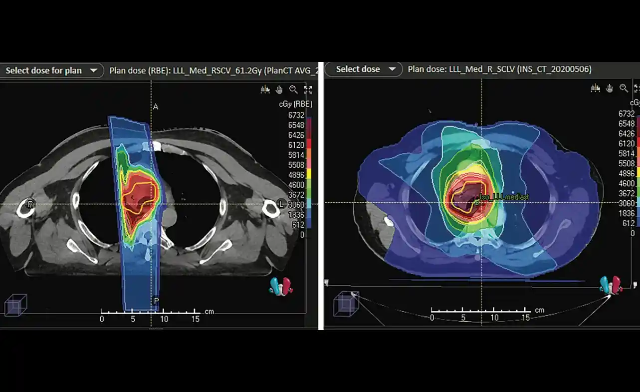 Proton Therapy for Lung Cancer