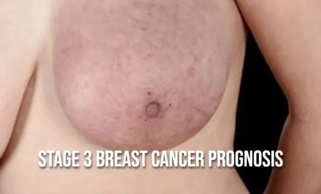 Stage 3 Breast Cancer Prognosis