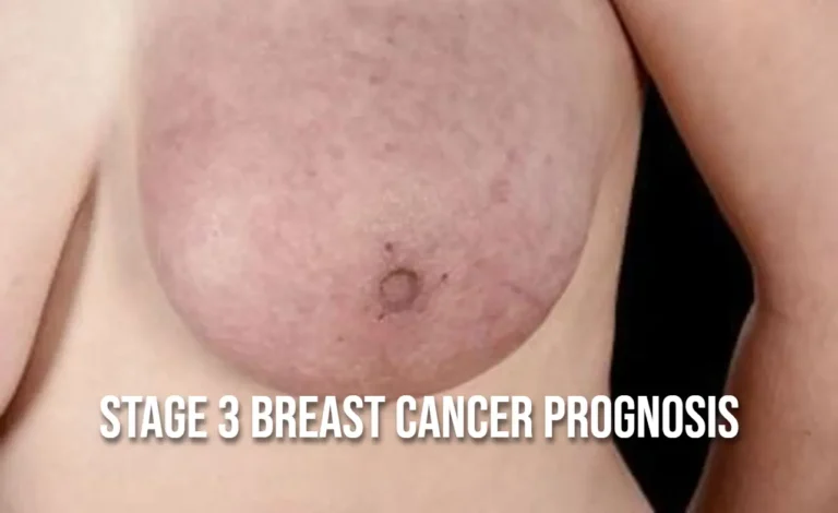 Stage 3 Breast Cancer Prognosis