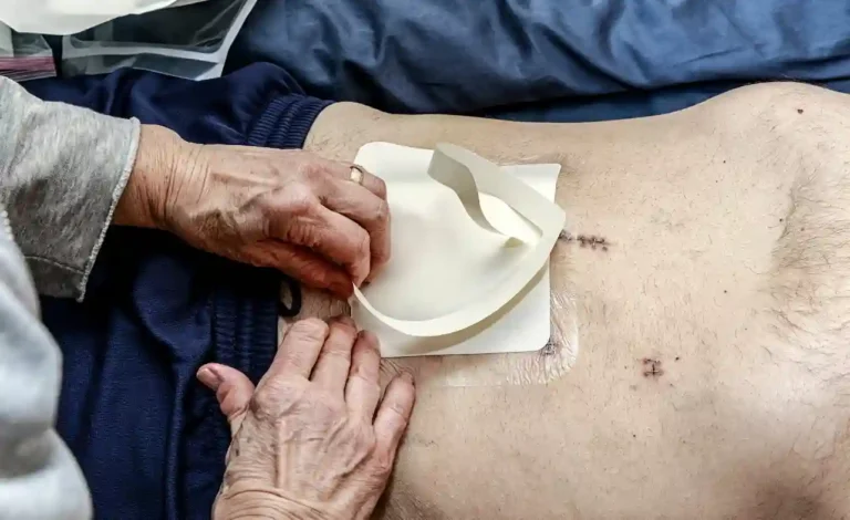 Stage 3 Colon Cancer Life Expectancy Without Treatment