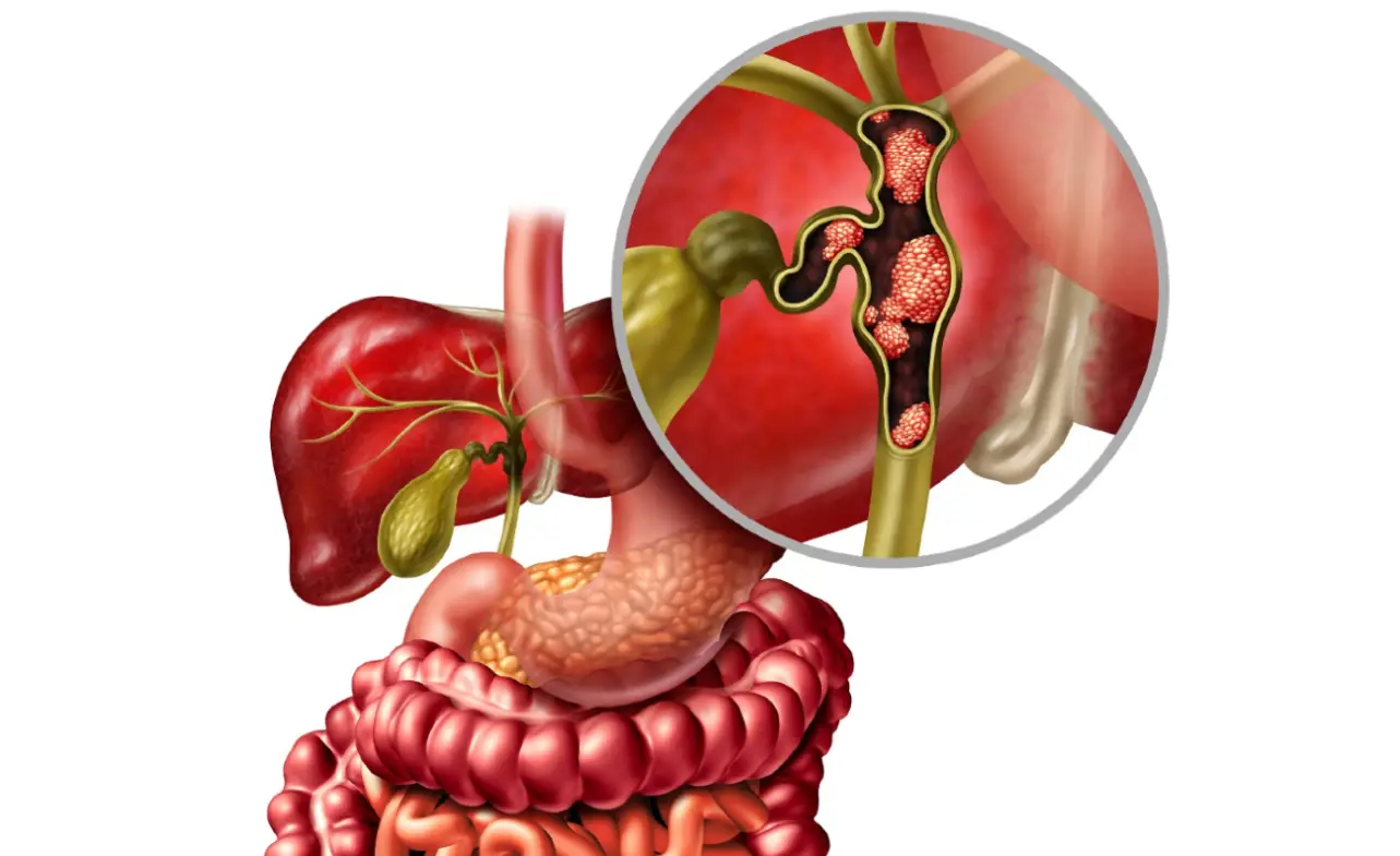 Stage 4 Bile Duct Cancer Life Expectancy