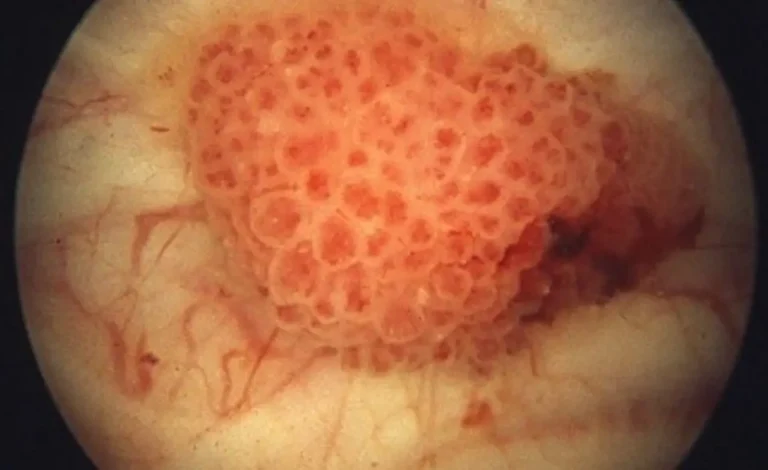 Stage 4 Bladder Cancer Life Expectancy
