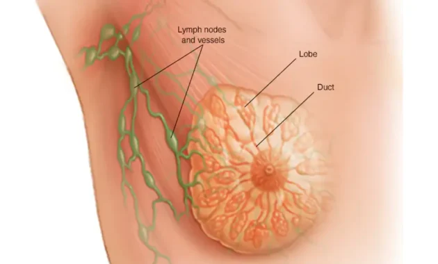 Stage 4 Breast Cancer Life Expectancy Without Treatment