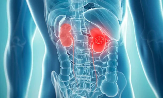 Stage 4 Kidney Cancer Spread to Lungs Life Expectancy