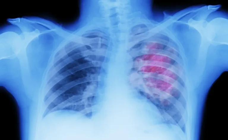 Stage 4 Lung Cancer Life Expectancy Without Treatment