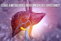 Stage 4 Metastatic Liver Cancer Life Expectancy