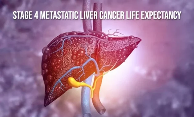 Stage 4 Metastatic Liver Cancer Life Expectancy