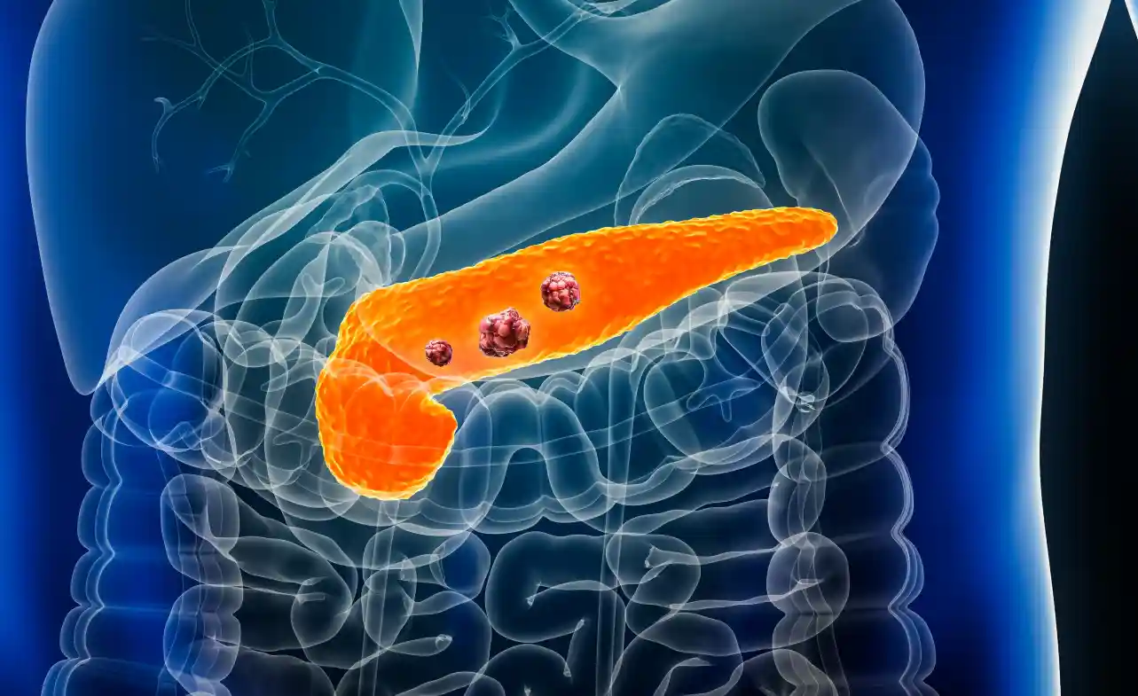 Stage 4 Neuroendocrine Pancreatic Cancer Life Expectancy Stage 4 Pancreatic Cancer Life Expectancy 2024