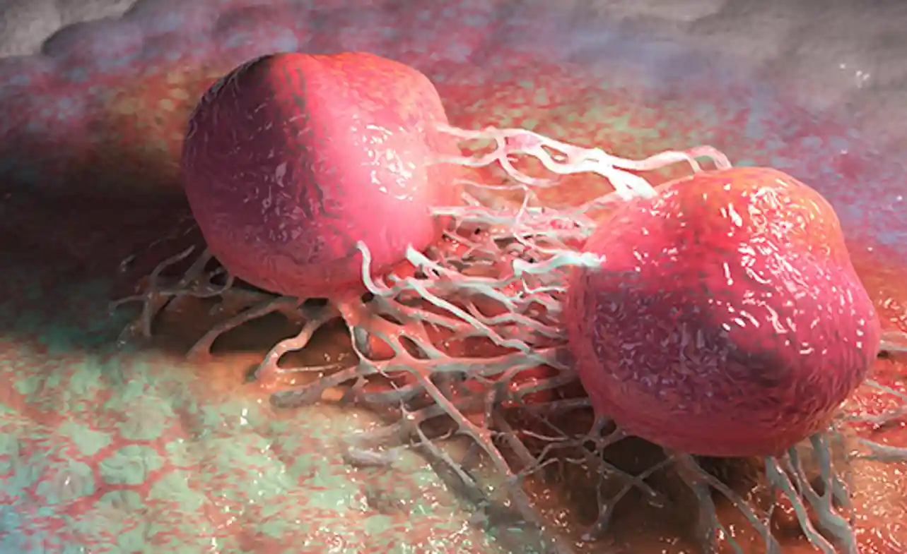 Stage 4 Prostate Cancer Spread To Bones Life Expectancy