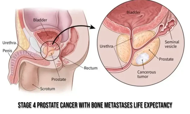 Stage 4 Prostate Cancer with Bone Metastases Life Expectancy