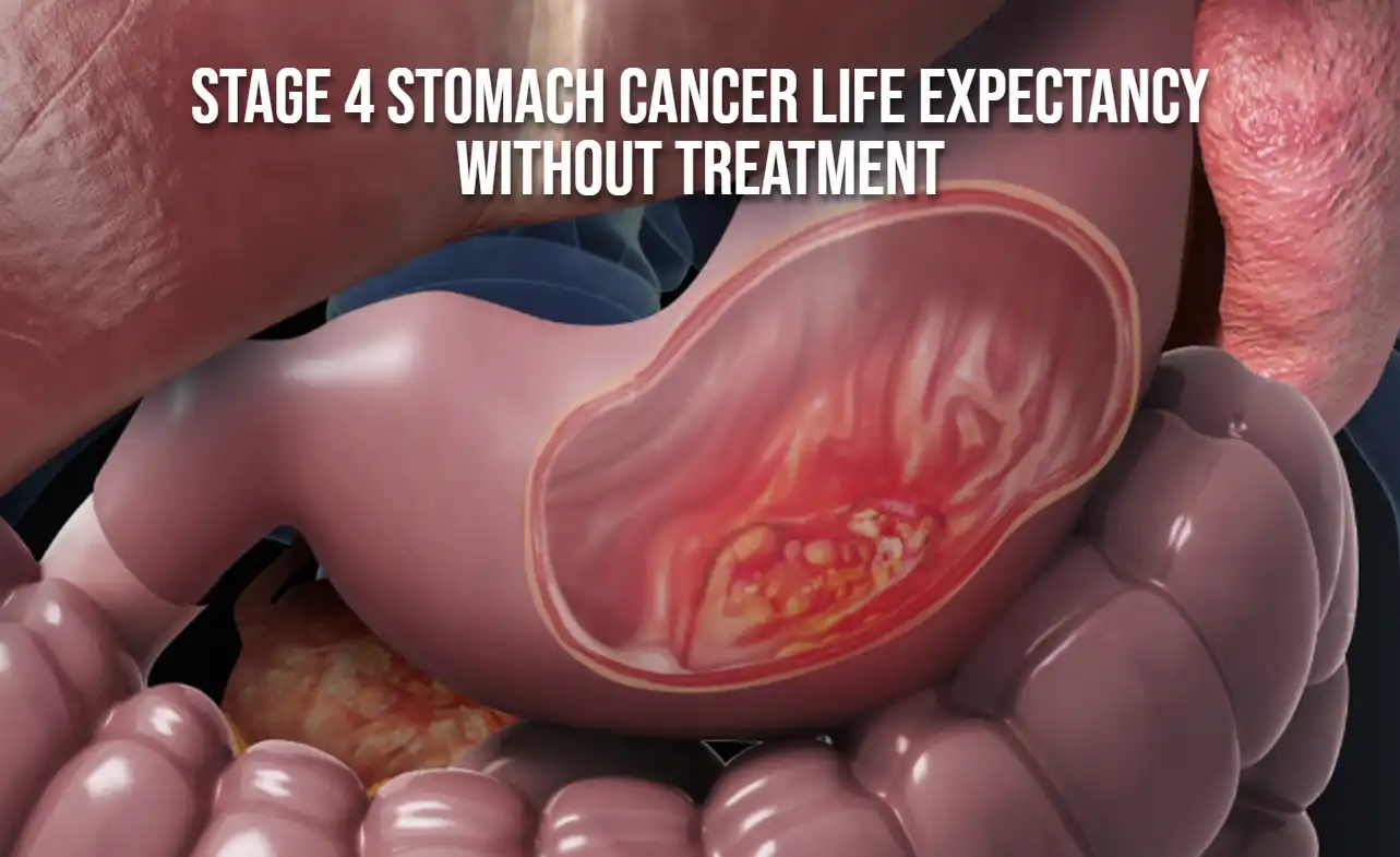 Stage 4 Stomach Cancer Life Expectancy Without Treatment