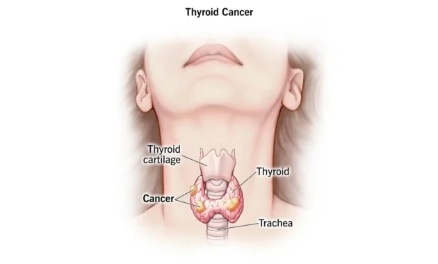 Stage 4 Thyroid Cancer Life Expectancy