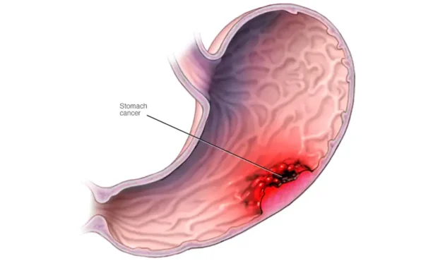 Stomach Cancer Misdiagnosis