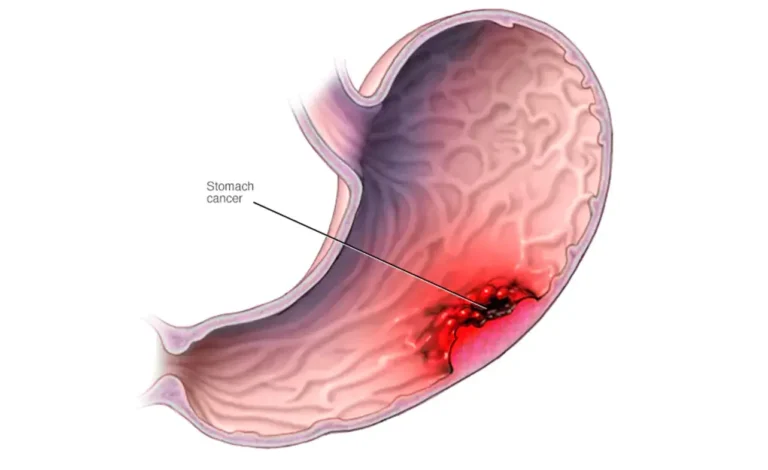 Stomach Cancer Misdiagnosis