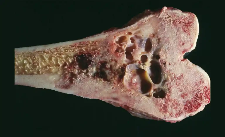 Survival Rate of Stage 4 Bone Cancer