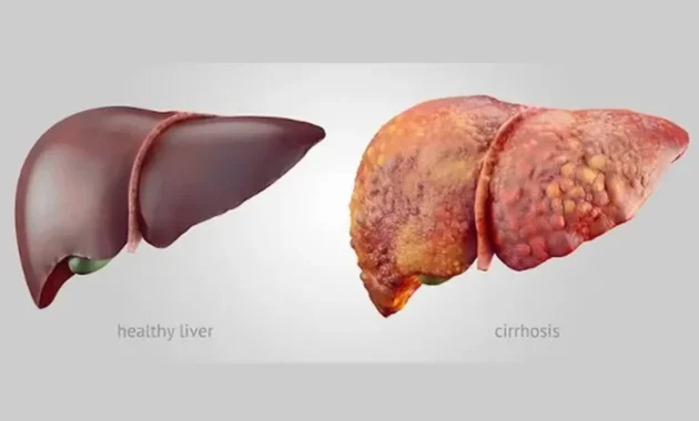 What is the Life Expectancy of Someone with Liver Cancer