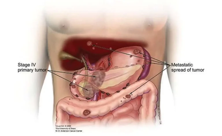 What to Expect with Pancreatic Cancer Stage 4