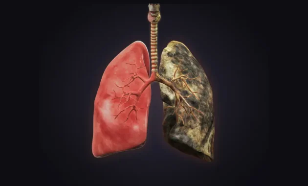 inoperable lung cancer life expectancy