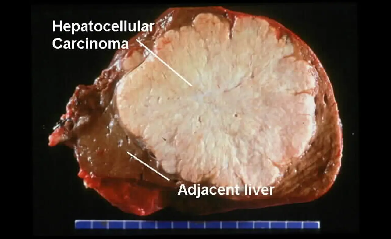 liver cancer stage 4 life expectancy