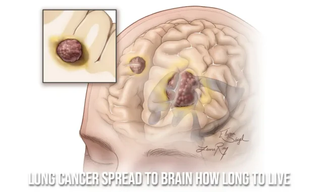 lung cancer spread to brain how long to live