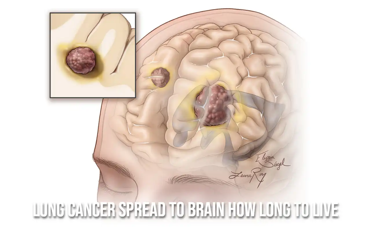 lung cancer spread to brain how long to live