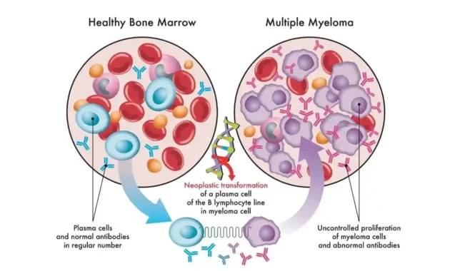 multiple myeloma life expectancy after stem cell transplant