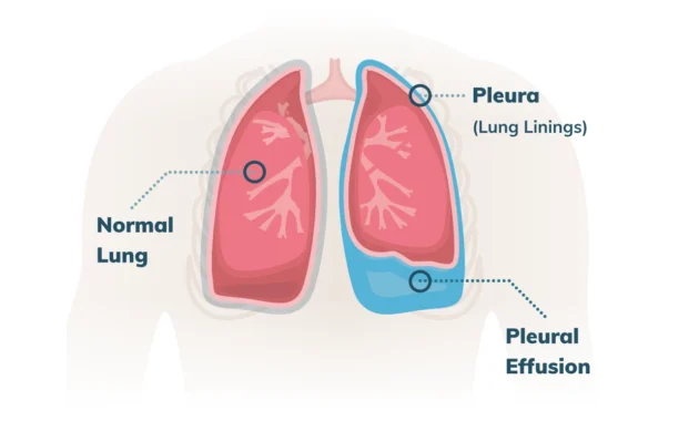 Pleural Effusion Cancer Life Expectancy