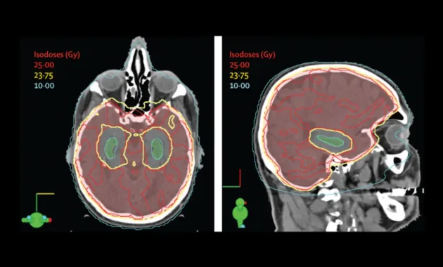 prophylactic cranial irradiation