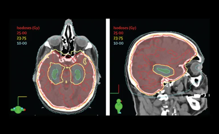 prophylactic cranial irradiation