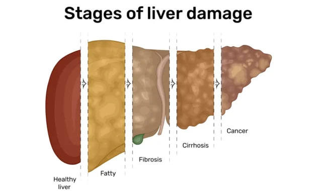 stage 1 liver cancer life expectancy