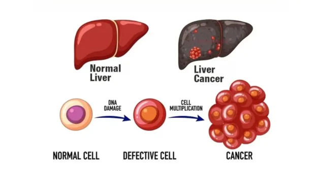 stage 3 liver cancer life expectancy