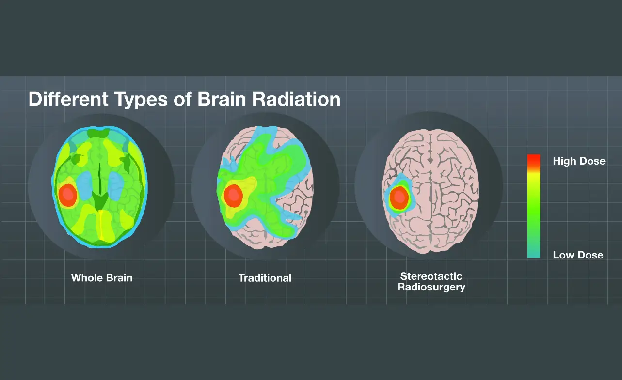 Side Effects of Brain Radiation for Lung Cancer