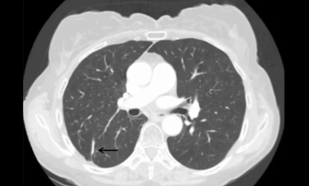 recurrence of lung cancer after lobectomy