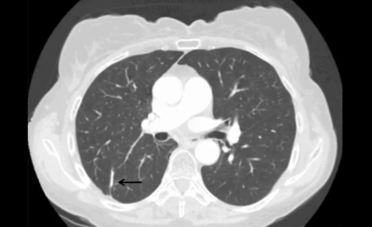 recurrence of lung cancer after lobectomy