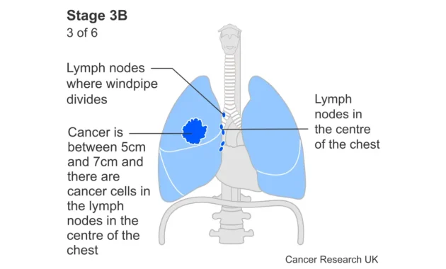 Can Stage 3B Lung Cancer go Into Remission