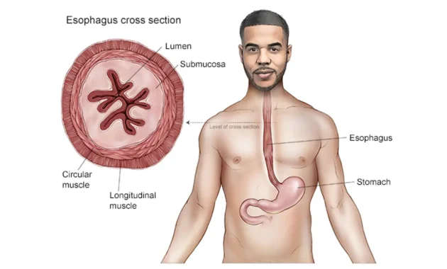 Esophageal Cancer Spreads to The Lungs