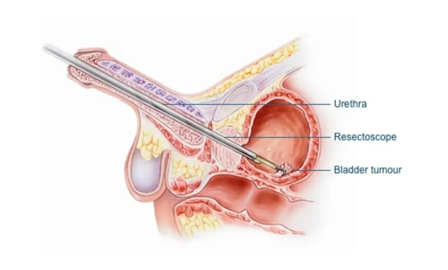 Transurethral Resection of Bladder Tumor