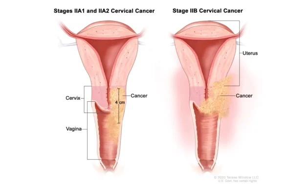 treatment for stage 3 cervical cancer