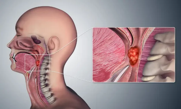 Oropharyngeal Cancer