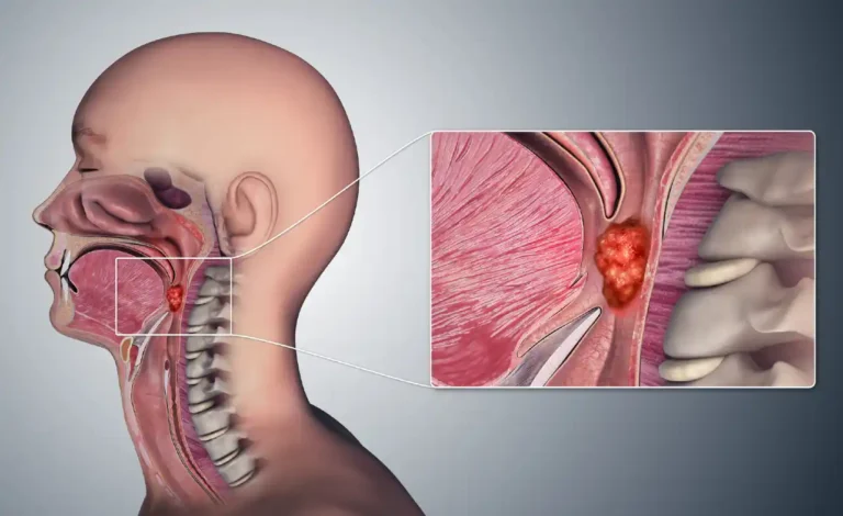Oropharyngeal Cancer