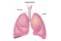 Epidermal Growth Factor Receptor Mutations in Lung Cancer