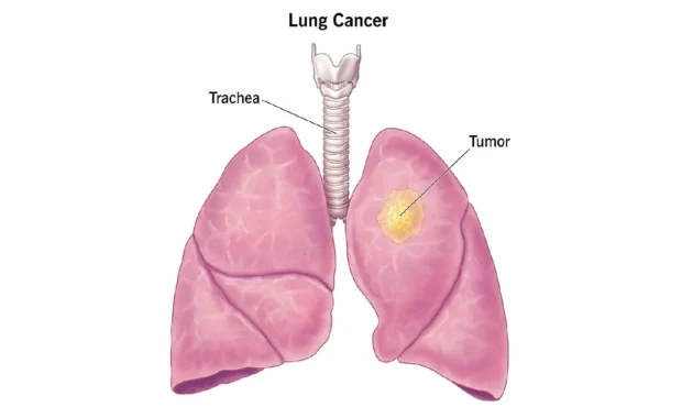 Epidermal Growth Factor Receptor Mutations in Lung Cancer