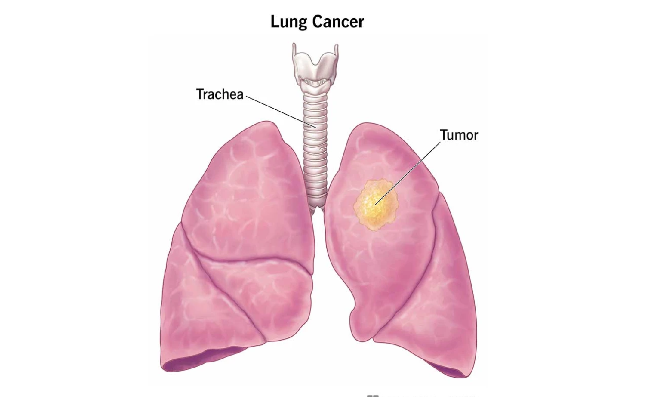 Epidermal Growth Factor Receptor Mutations in Lung Cancer