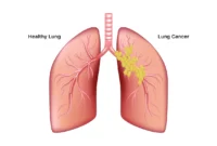 Stage 2 Lung Cancer Treatment