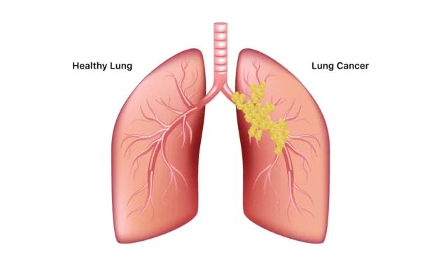 Stage 2 Lung Cancer Treatment