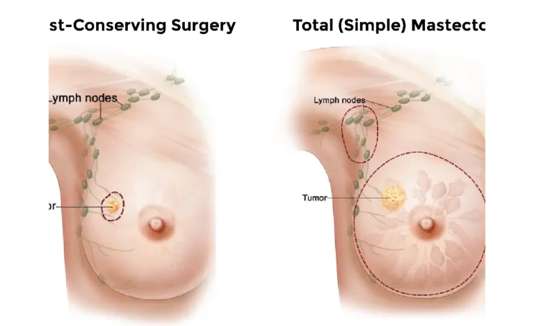 Treatment for Triple-Negative Breast Cancer