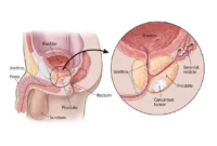 Unlocking the ICD-10 Code for Prostate Cancer